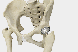 Outpatient Total Hip Replacement