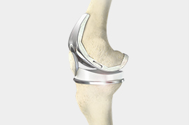 Outpatient
                                    Total Knee Replacement