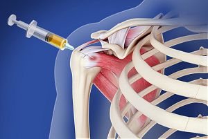 Platelet Rich Plasma