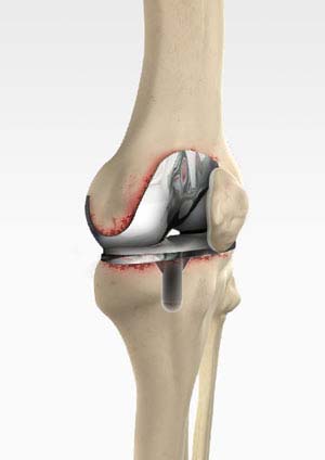 Revision
                                    Knee Replacement