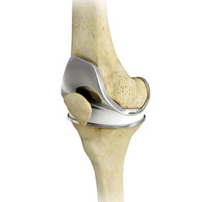 Journey II - Total Knee Replacement